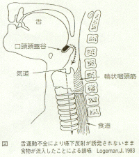 舌運動不全により嚥下反射が誘発されないまま食物が流入したことによる誤嚥の説明図